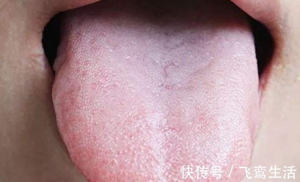 舌苔|学会看自己的舌像,有些癌症或许就能早发现!