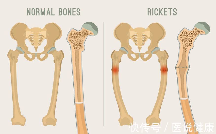 神经病变|脚经常疼痛,或与5个因素有关,别忽视病症带来的危害,及时检查