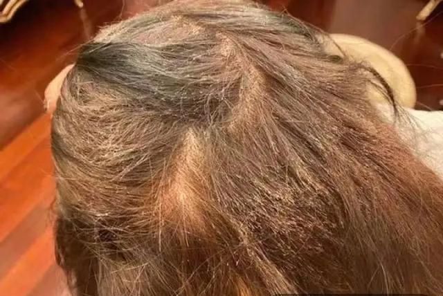 头发|“赔偿我20万元钱!”女生花1000元染发后,变“狗啃式”出不了门