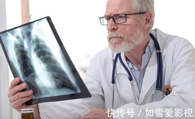 就医|女子双肺多发结节，一个已癌变！一旦查出这结节，建议尽快就医