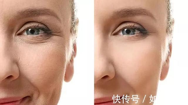 胶原纤维 跟风做的医美项目没有用?选对很重要!