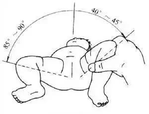 发育不良|宝宝髋关节发育不良戴吊带矫正会影响腿型吗
