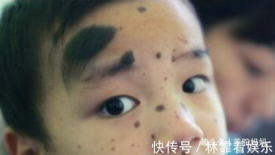 化学物质|越来越多胎儿被“胎记”缠身,若不想孩子自卑,孕妈要管住自己