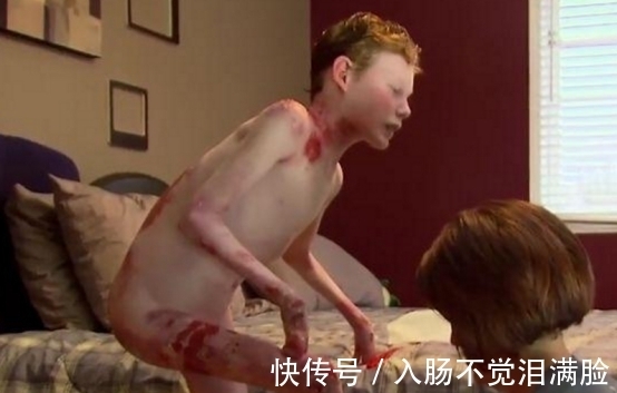 乔纳森|男孩皮肤一碰就流血,每天裹满纱布,泡在浴缸里减轻痛苦