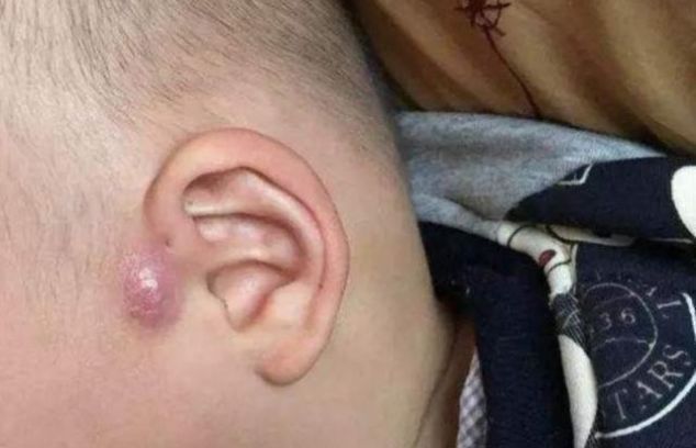 耳朵|孩子耳朵旁边长出“聪明孔”,奶奶好奇挤了一下,不料却惹了麻烦