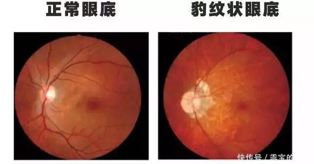 玻璃膜|近视超过600+?我建议你看看自己的眼底,绝对惊恐!