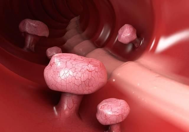 排便|大肠息肉开始癌变,排便时有四个信号,若四个都有,提示该检查了