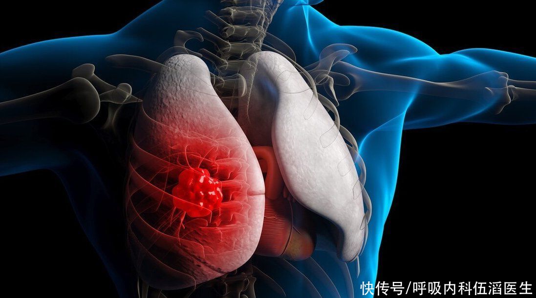 肺癌早期|医生:这种咳嗽,是肺癌早期的第一个高危信号,还很容易被忽视掉