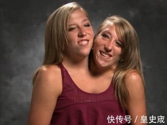 去世|“连体人”中一人不幸去世,另一人会怎么样?看完算是明白了