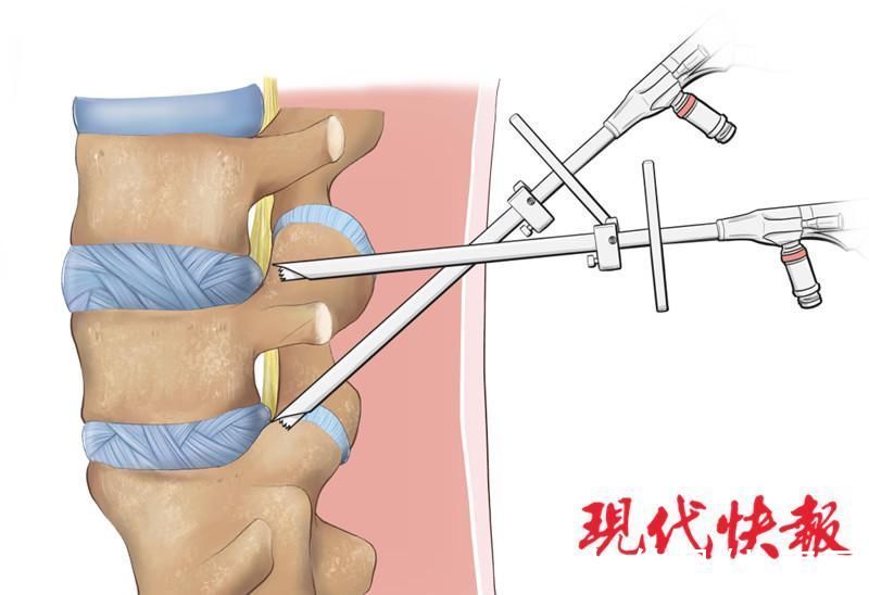 腰椎|警惕！这种病已盯上青少年，17岁女孩腰椎“双重”突出