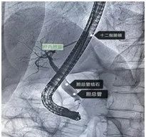 张凯|【技术服务】汶上县人民医院成功开展ERCP手术