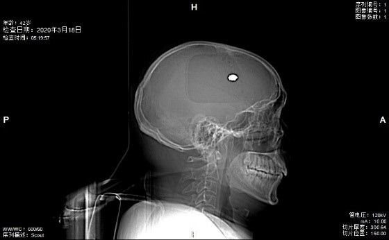 病患|钢珠射穿男子左眼后进入颅内，左右游走后癫痫发作，两次手术后，医生为其取出钢珠