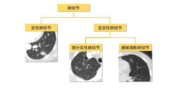 癌变|超一半人群都有的肺结节，到底会不会癌变？专家解析→