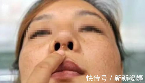 假体|为什么你做的隆鼻没达到预期效果?吸取教训,这些雷别踩!