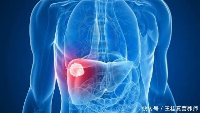 肝癌|985女大学生一周7次“857”,因腹痛确诊肝癌,坚持2个月后离世