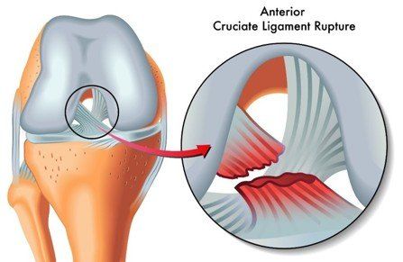 有关前交叉韧带损伤应该了解的知识 快资讯