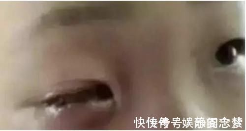 干燥剂|仅仅20分钟,男孩右眼眼珠被溶化,家里的这件小东西父母要警惕!
