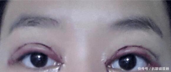 手术|做过双眼皮手术的年轻人,老了以后眼睛会怎么样?看来是这个道理