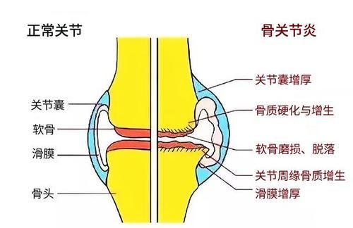 医生|膝关节退变疼痛难忍，吃点对乙酰氨基酚就行了，不用看医生？