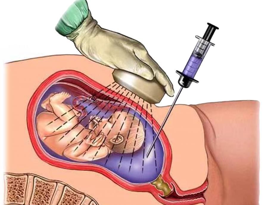 血管瘤|孕妇羊水过多,危及母婴安全!手术放出15斤羊水