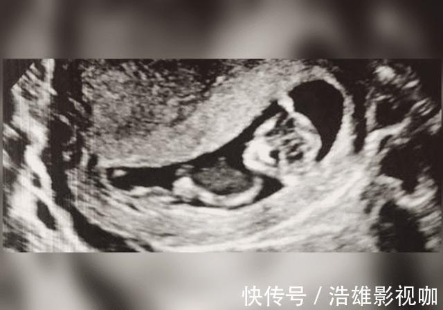 宝宝|最美胎记!双胞胎姐姐“消失”在腹中,化为胎记印在弟弟腿上