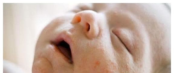 婴儿|冬季天气干冷,宝宝容易爆发湿疹?可能只是父母这三件小事没做对