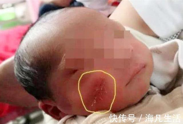 宝宝|5年前因吃奶太用力,被妈妈刮成“花脸猫”的宝宝,如今怎么样了