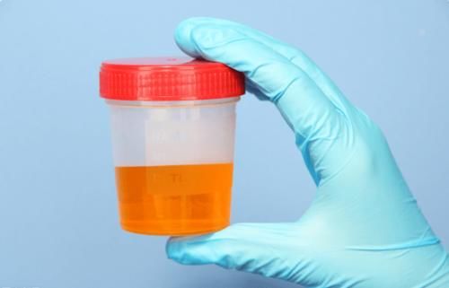 肾穿刺|关于尿蛋白，必须了解的4项问题