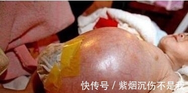 吓坏|四岁男童肚子很大,刚开始以为是肿瘤,真相吓坏所有人!