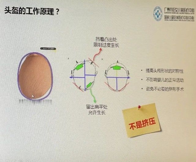 婴儿|“婴儿网红头盔”大火！可有家长发现孩子像“奥特曼”了