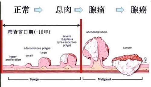 息肉|一定要看胃息肉会癌变吗?癌变几率有多大?