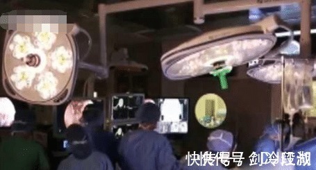 过敏|男子流“鼻涕”五年以为是过敏, 滴到碗里后才“发现”是脑脊液