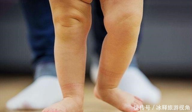 检查|2岁孩子O型腿,需要去医院检查吗家长有必要知道这些