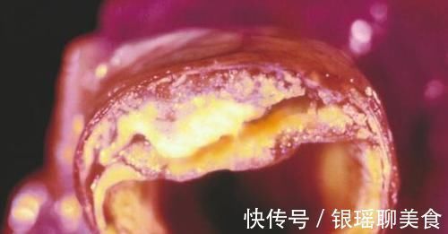 脂质|甘油三酯偏高,注意2吃、2少吃,降低甘油三酯,早了解早受益!