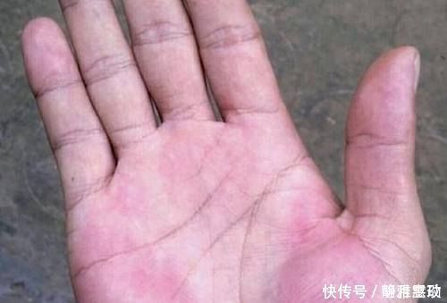 降糖穴|血糖高不高先看手，没有这3个变化，说明血糖很好