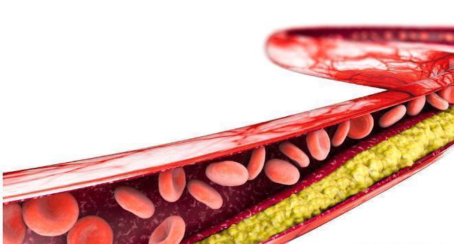 胆固醇|坚持走路运动,真的可以逆转动脉硬化吗