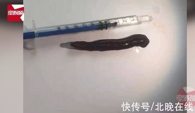 鼻内镜|男孩鼻塞半月后取出一条蚂蟥，家属直呼：太吓人