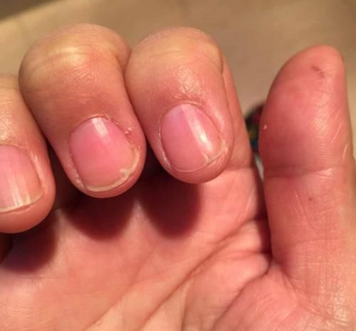 张大哥|43岁男子滴酒不沾，确诊肝癌，化疗4次离世，医生：这2物怎能常吃