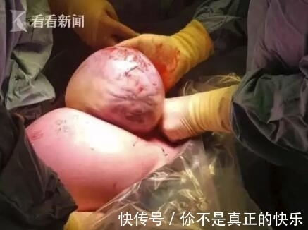 柔伊|医生从妈妈肚子里取出一个肉球!网友:这是哪吒啊