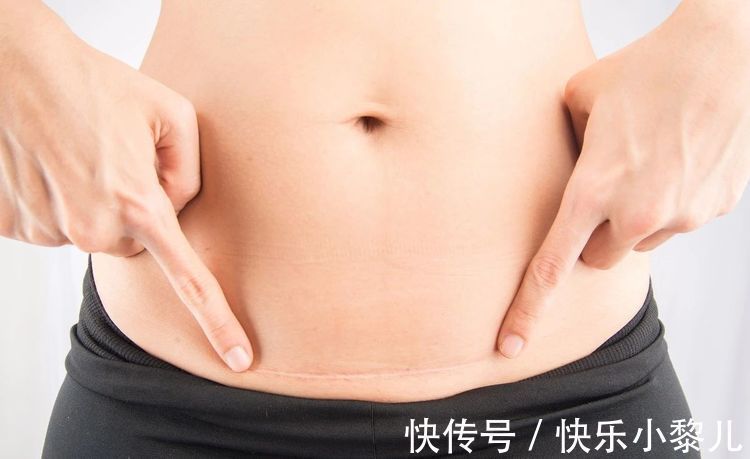 顺产|剖腹产的切口何时才能“完全愈合”?还没恢复前,这件事不要做