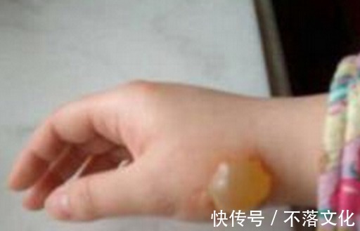 伤处|5岁孙子被开水烫伤,奶奶临危不乱及时处理,获医生称赞 !