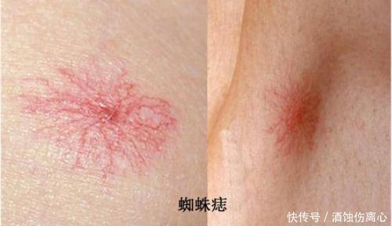 73岁老奶奶，从重度肝硬化到肝功正常，半年只用了1个诀窍