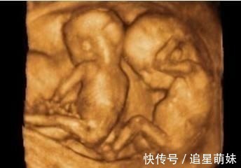 医生|孕妈怀上三胞胎全家开心，医生抱出第三个孩子后，又有意外发现！