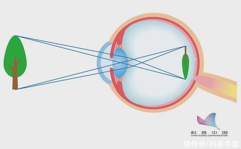 高度近视|近视手术能不能做?想做又怕后遗症的,你需要的科普来了