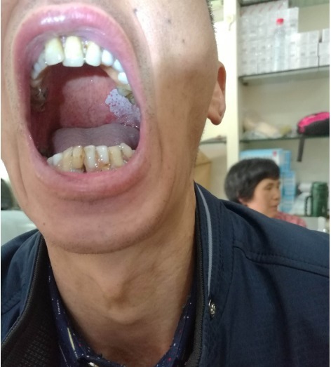 白斑|癌症形成期基本在36~45岁,若你没有这些现象,说明身体还算健康