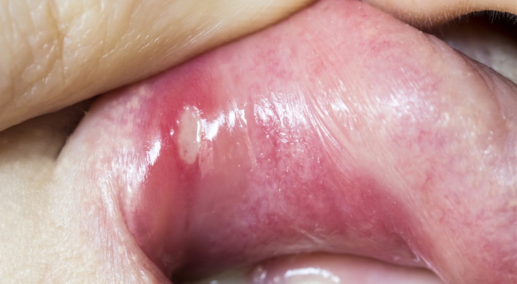 痊愈|得了口腔溃疡就是上火了医生教给3个办法,快速痊愈,吃嘛嘛香