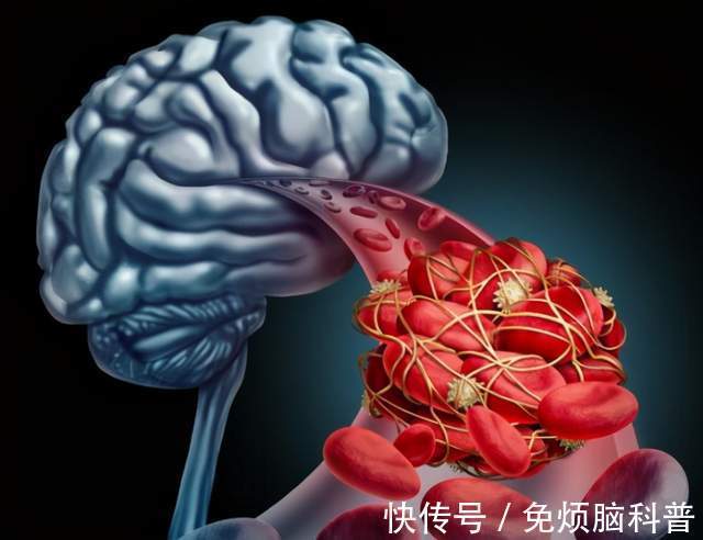 诱发|为何越来越多老人中风?这些因素是凶手,做好四点预防,很有必要