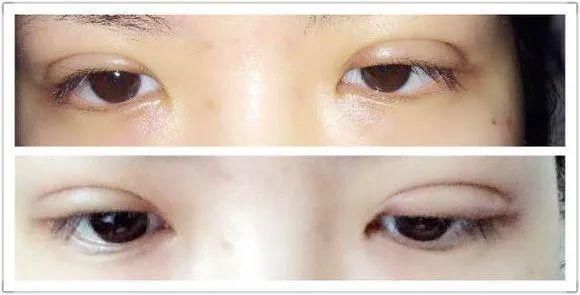 组织|双眼皮术后出现肉条的不同原因和修复方法