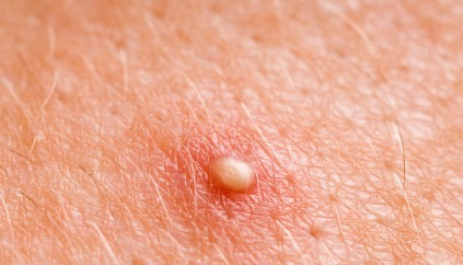 感染|26岁空姐查出宫颈癌,医生皮肤长有“小疙瘩”,拖成了宫颈癌