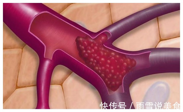 心脑血管疾病|经常吃“腐乳”的人,最后怎样了或许少数人才知道,不妨看看吧